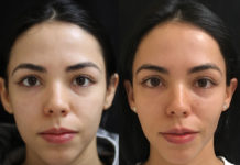 Vampire Facial Treatment