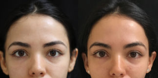 Vampire Facial Treatment