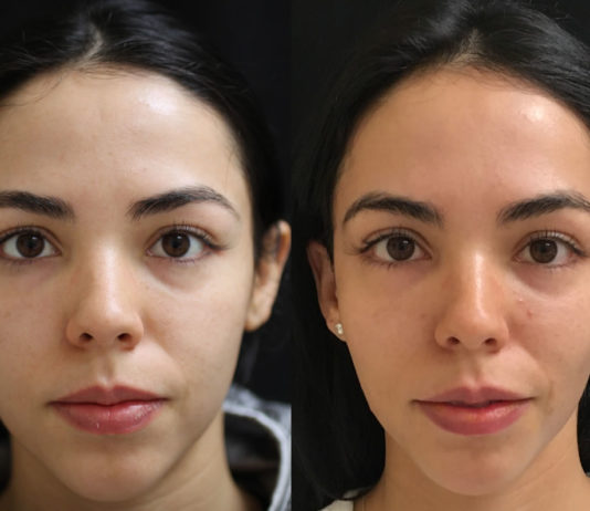 Vampire Facial Treatment