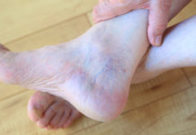 Spider Vein Treatments