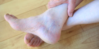 Spider Vein Treatments