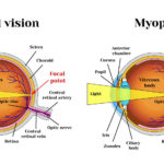 9 Ways to reduce the effects of myopia naturally