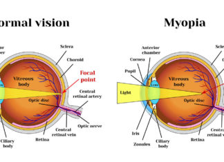 9 Ways to reduce the effects of myopia naturally