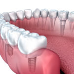8 Things You Should Know Before You Get Dental Implants Dental Implants