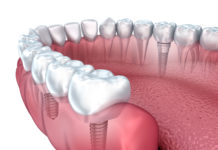 Dental Implants