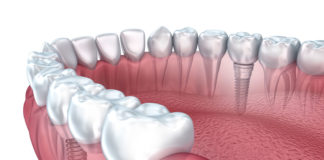 Dental Implants