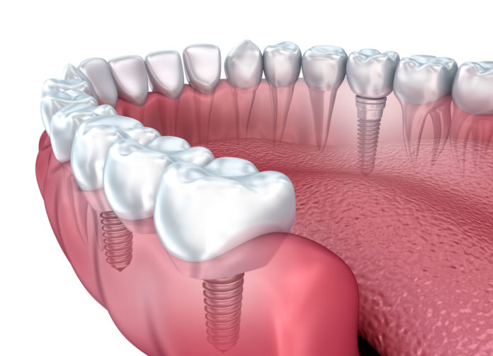 Dental Implants