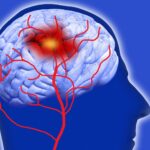 What Are The Telling Symptoms Of An Oncoming Brain Stroke? Brain Stroke