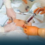Bone Marrow Transplant: Procedure and Cost Bone Marrow Transplant