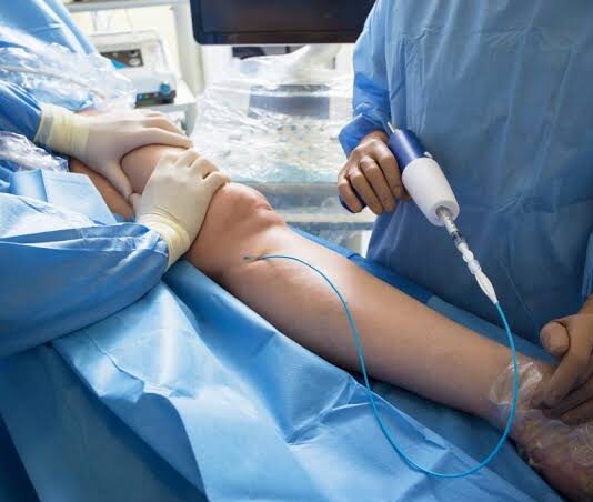 Preparing for a Fistula Operation Before Starting Dialysis Fistula Operation For Dialysis
